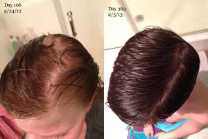 Patient undergoing TSW sees improvement in hair loss over time